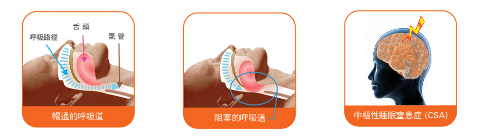 阻塞性睡眠窒息症